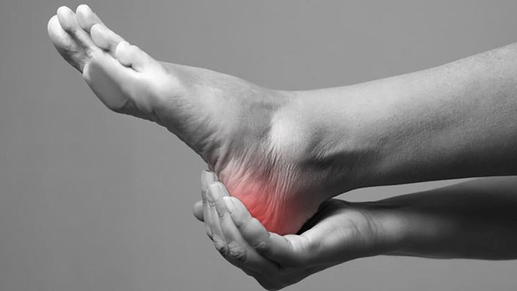 fascitis plantar