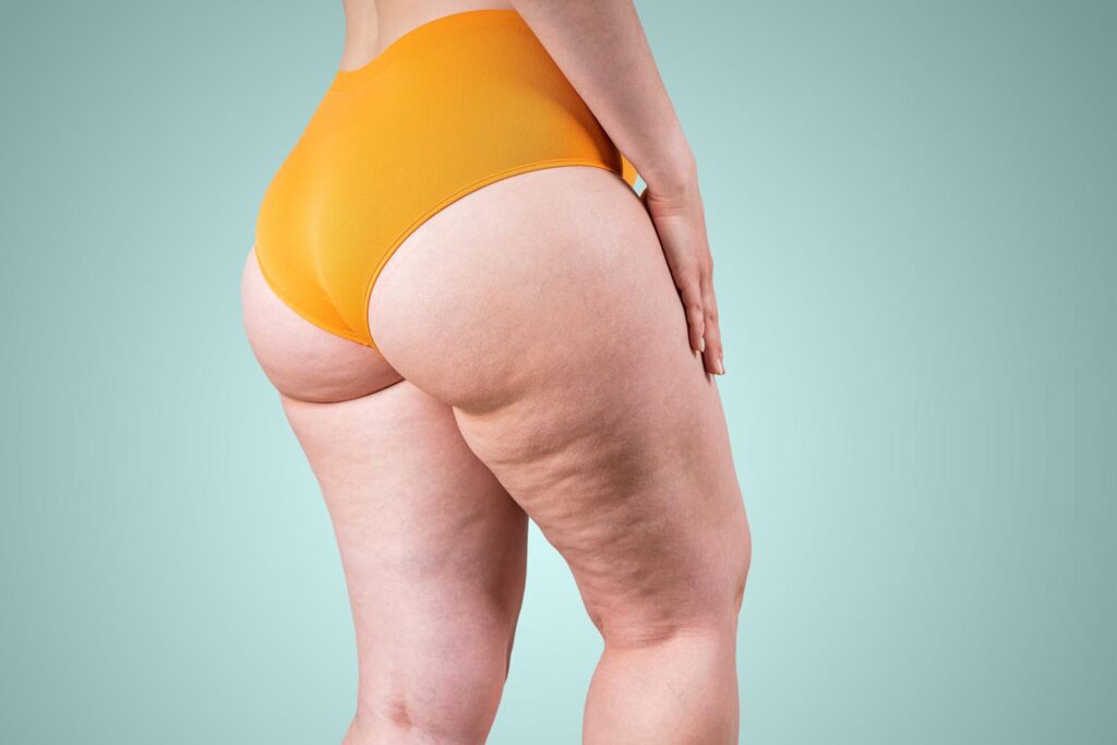 lipedema